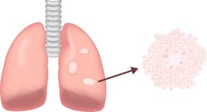 sarcoidosis of lung