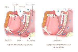 Obstructive Sleep Apnea Expert