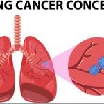 lung cancer