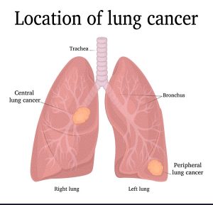 lung cancer location