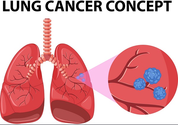 What is Lung Cancer | Stages of Cancer | Dr. Virendra Singh