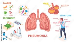 Pneumonia Causes