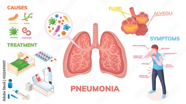 What Causes Pneumonia | Can you die from pneumonia | Dr. Virendra