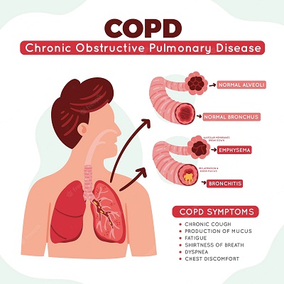 Types And Stages Of Copd 