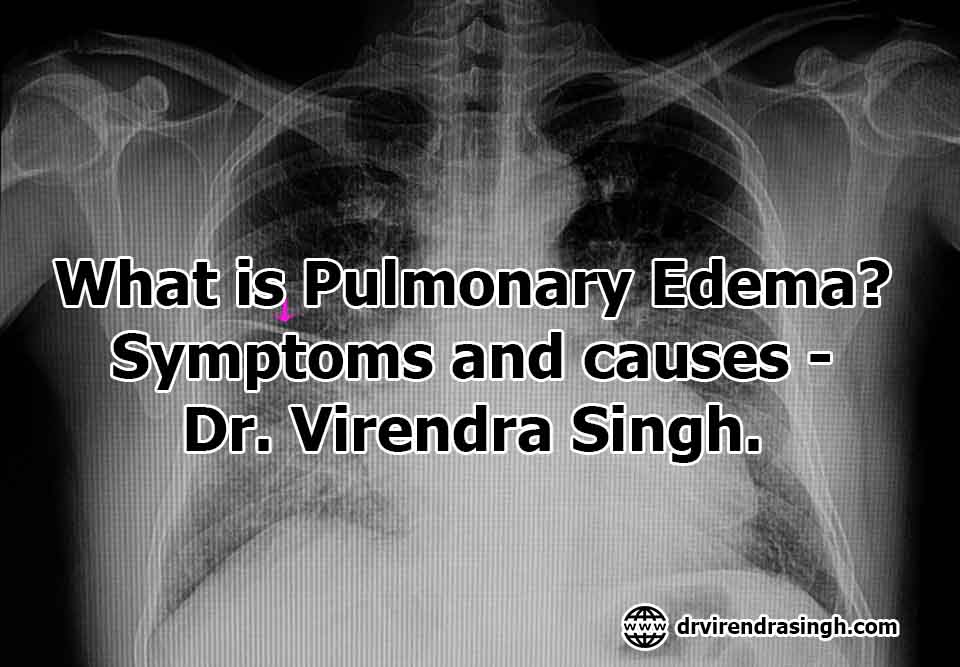 What is Pulmonary Edema? Symptoms and causes- Dr. Virendra Singh.
