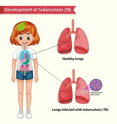 TB Tuberclosis