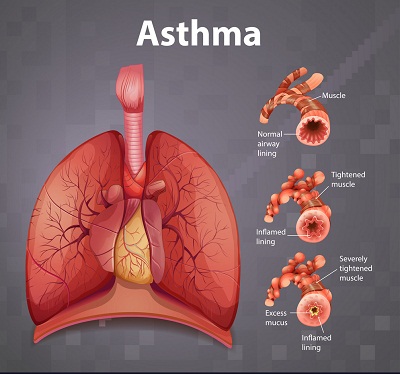 What is asthma