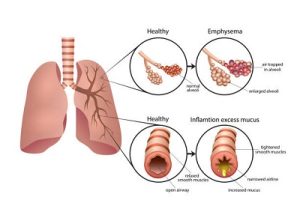 COPD - Dr. Virendra Singh