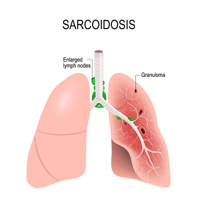 What is Sarcoidosis