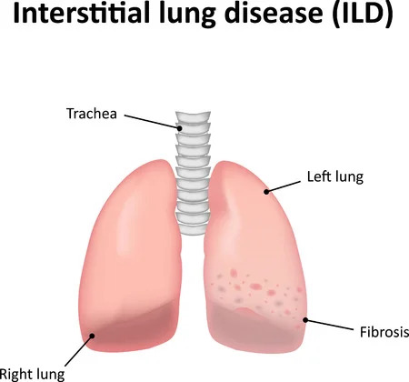 Interstitial lung disease ILD