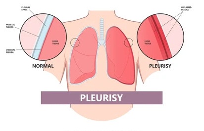 What is Pleurisy: Causes, Symptoms, Diagnosis - Dr. Virendra Singh