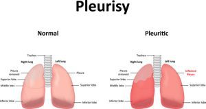 what is Pleurisy
